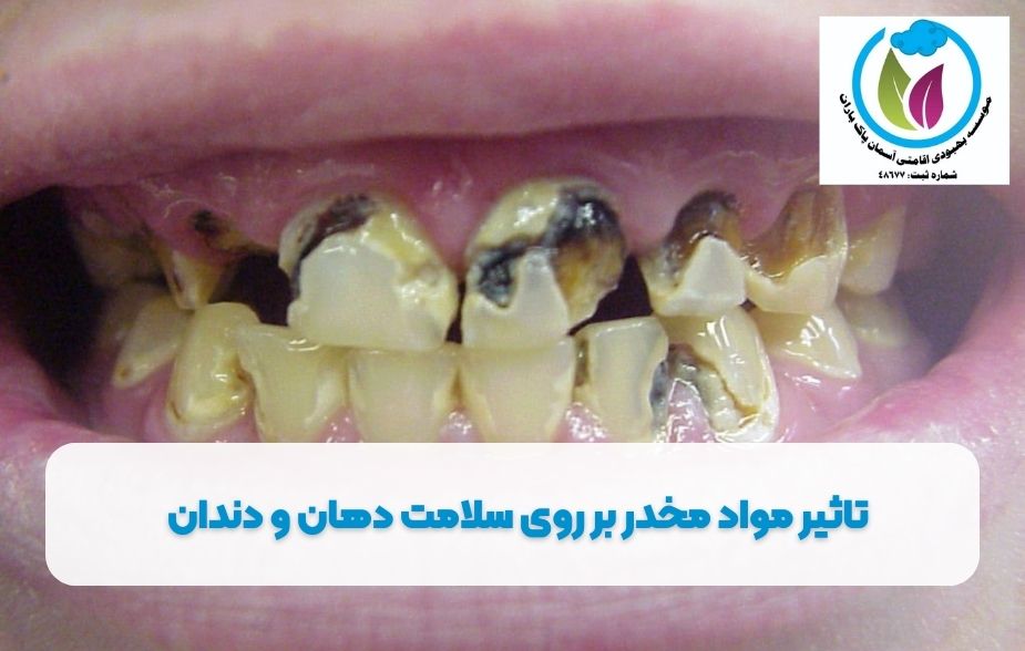 اثر مواد مخدر بر سلامت دندان